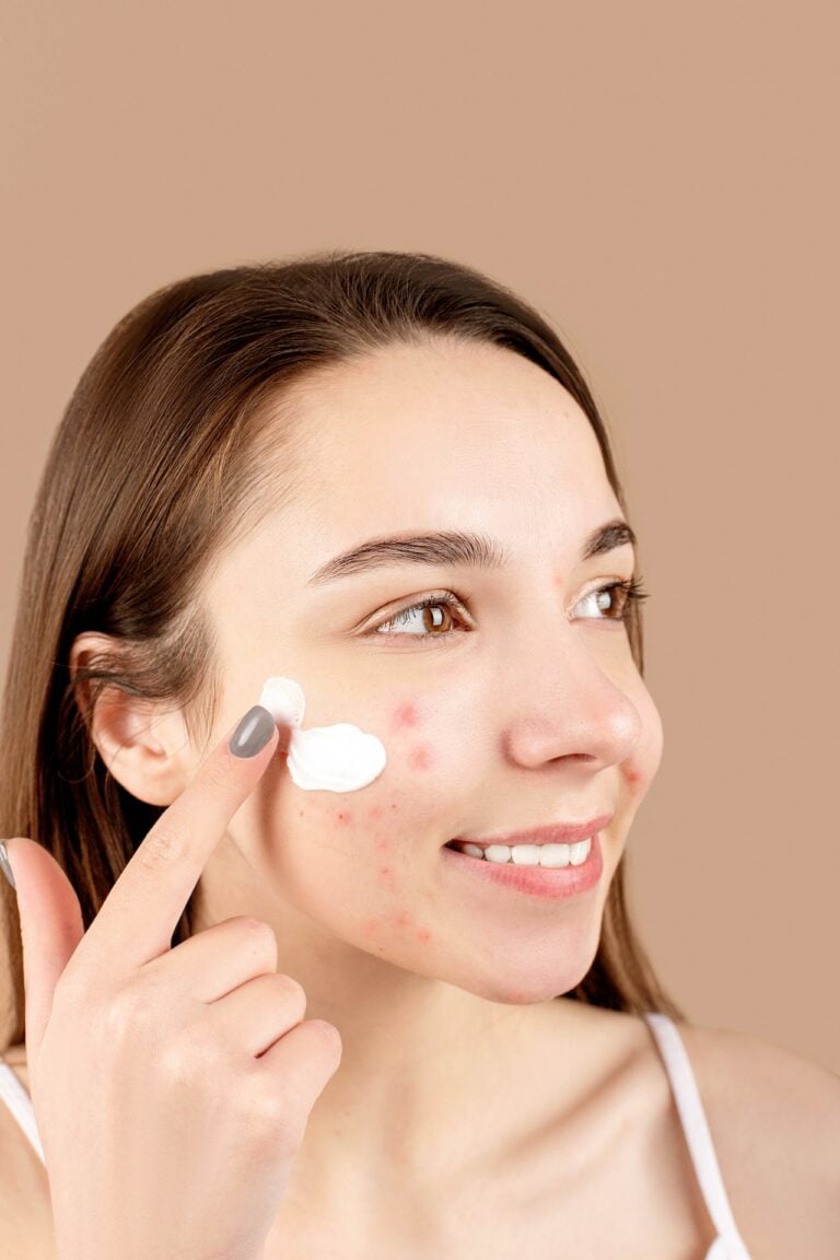 A Woman Putting Cream on Her acne spots