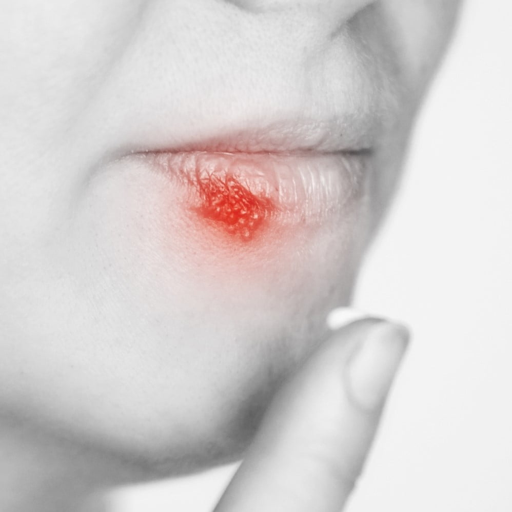 Girl with herpes. Sick mouth symptom. Lips cold. Red round concept. Finger near head. Woman face. Healthcare infection. Close view. Cold sores treatment.